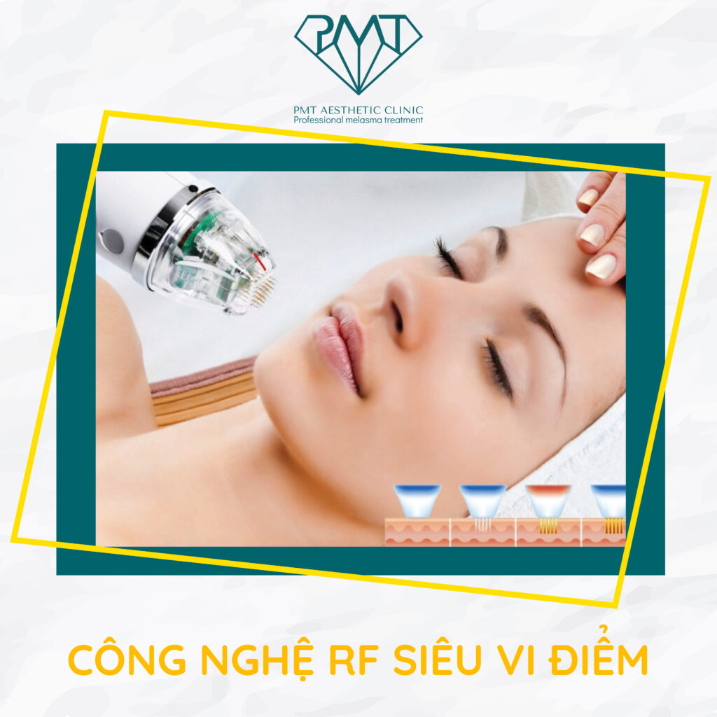 Ưu điểm của công nghệ Vi Kim RF