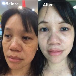 pmt-clinic-truoc-sau-17