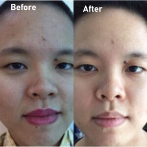 pmt-clinic-truoc-sau-18