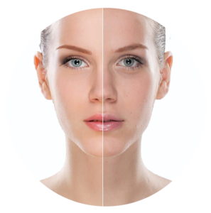 dịch vụ điều trị nám