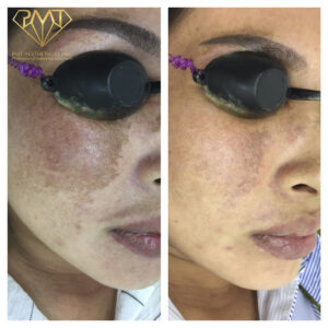 pmt-clinic-truoc-sau-01