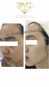 pmt-clinic-truoc-sau-02
