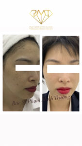 pmt-clinic-truoc-sau-03