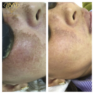 pmt-clinic-truoc-sau-04