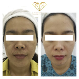 pmt-clinic-truoc-sau-05