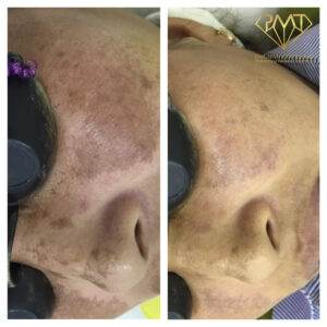 pmt-clinic-truoc-sau-06