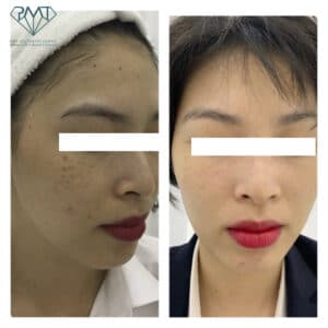 pmt-clinic-truoc-sau-07