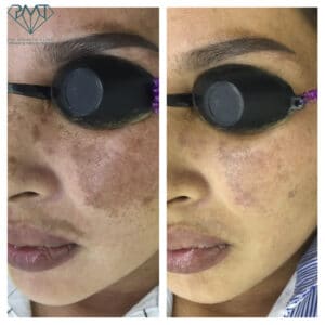 pmt-clinic-truoc-sau-08