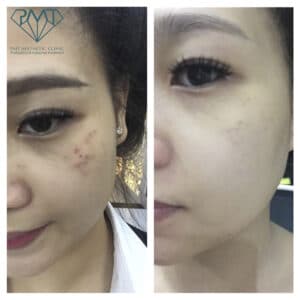 pmt-clinic-truoc-sau-09