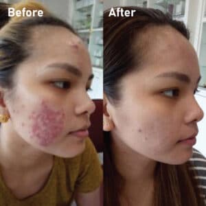 pmt-clinic-truoc-sau-10