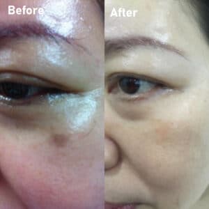 pmt-clinic-truoc-sau-11