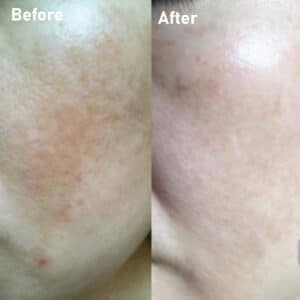 pmt-clinic-truoc-sau-12