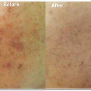 pmt-clinic-truoc-sau-13