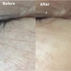 pmt-clinic-truoc-sau-14