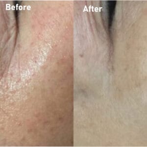 pmt-clinic-truoc-sau-15