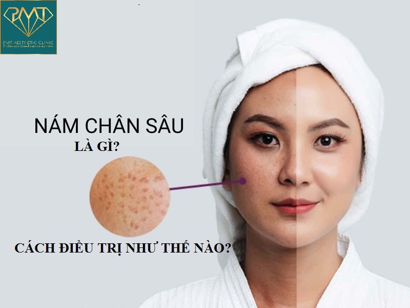 Nám chân sâu và cách điều trị như thế nào? - PMT Aesthetic Clinic