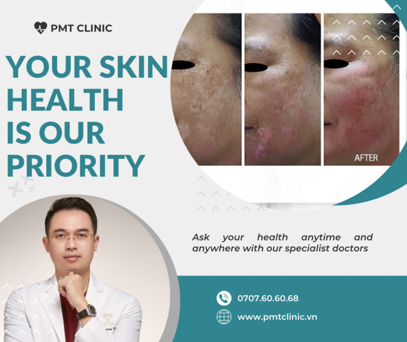 PMT đơn vị đầu tiên sở hữu Pallas UV laser trị bạch biến