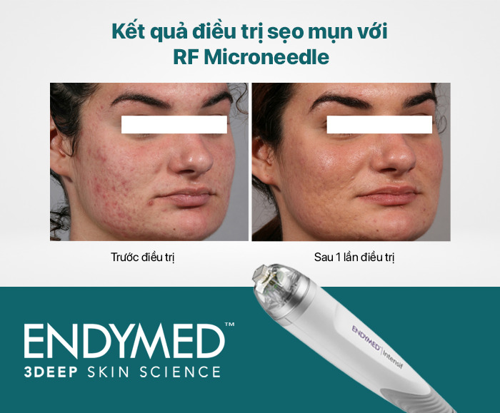 rf-microneedling