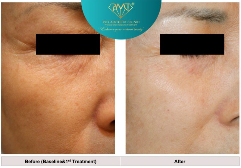 Khám phá liệu trình Sylpro: Giải pháp toàn diện cho nám, sẹo và da yếu